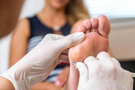 Corn Removal Treatment