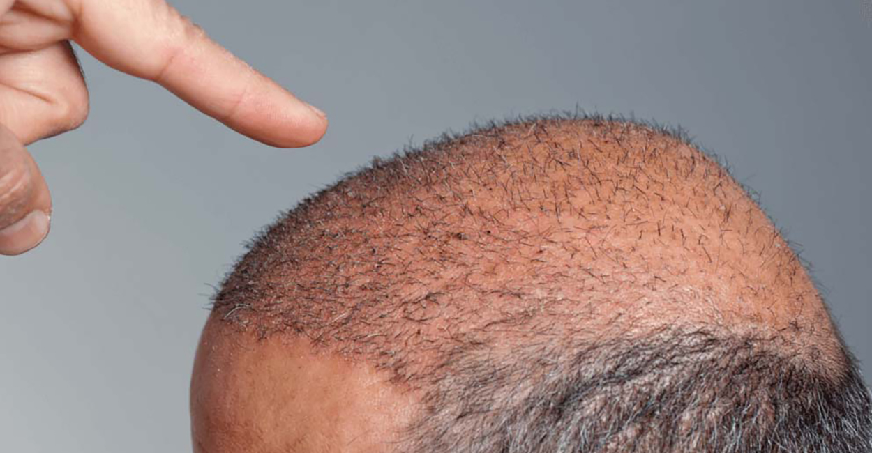 Hair Transplant