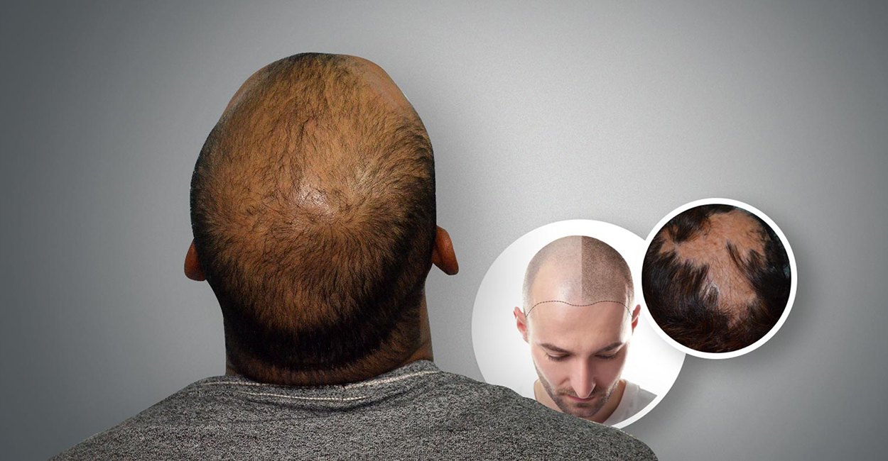 Scalp Micropigmentation