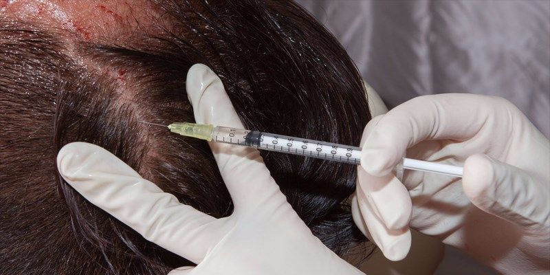 Intralesional Injection for Alopecia