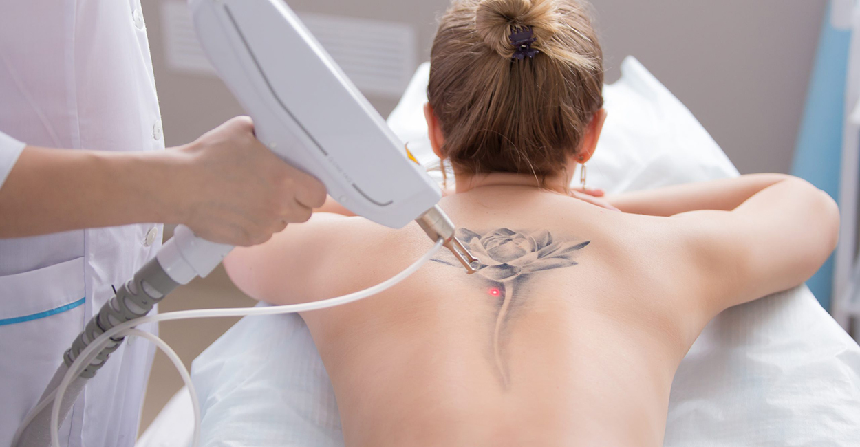 Laser Tattoo Removal