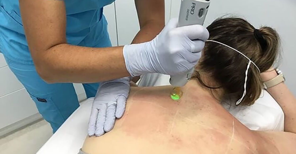 Laser for Pigmented lesions