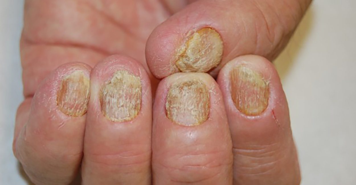Nail Diseases