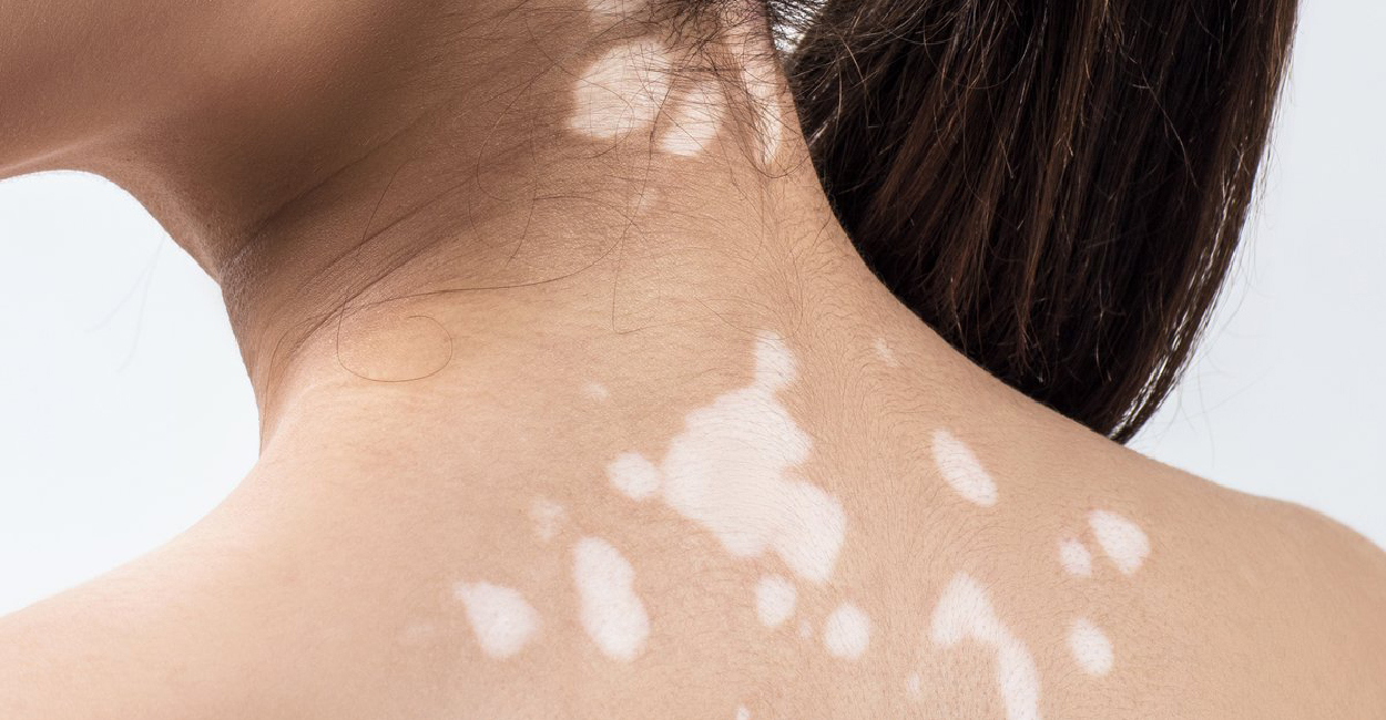 White Spot/ Vitiligo